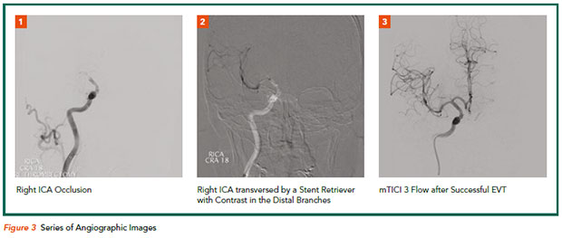 Hyper-acute stroke treatment - angiographic images - National Heart Centre Singapore