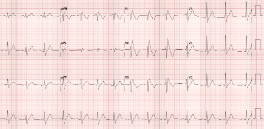 ecg