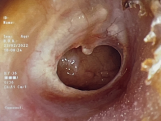 Tympanic membrane perforation - SGH