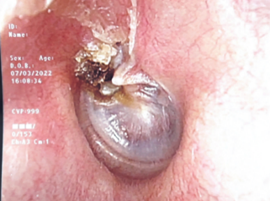 Cholesteatoma - SGH