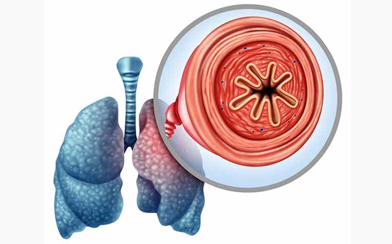 COPD Affects Non-Smokers Too