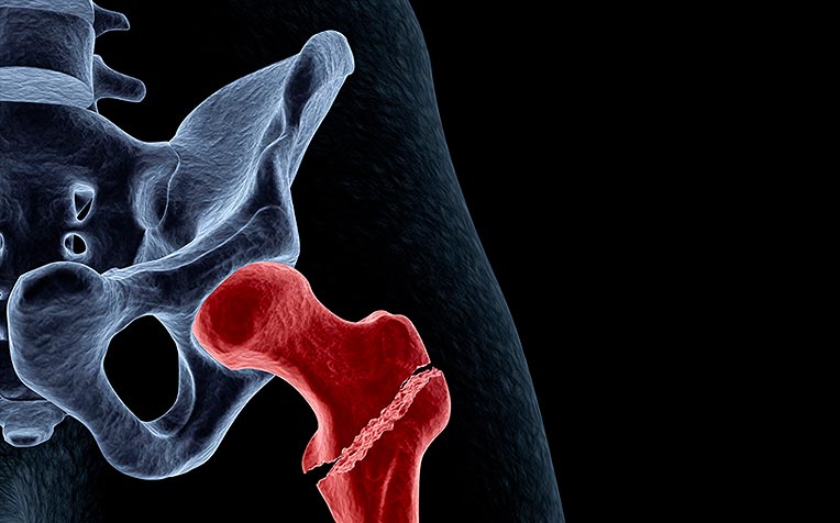 How Osteoarthritis and Hip Fracture Can Kill 